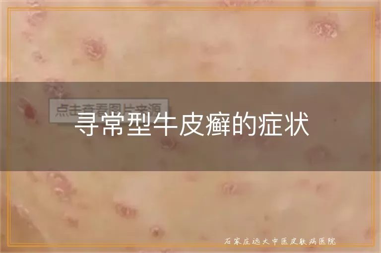 寻常型牛皮癣的症状