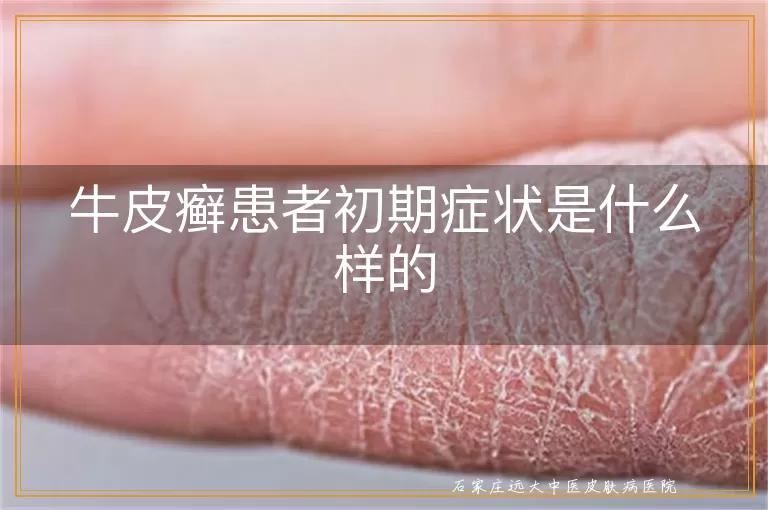 牛皮癣患者初期症状是什么样的