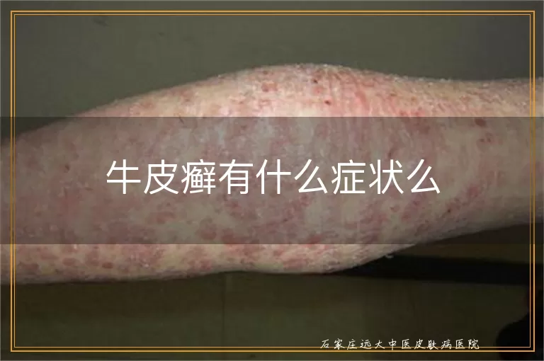 牛皮癣有什么症状么