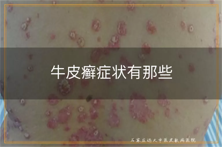 牛皮癣症状有那些