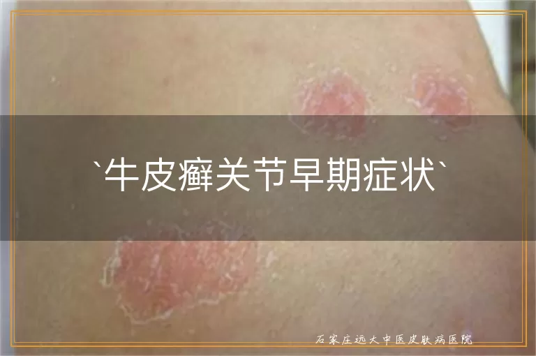 牛皮癣关节早期症状