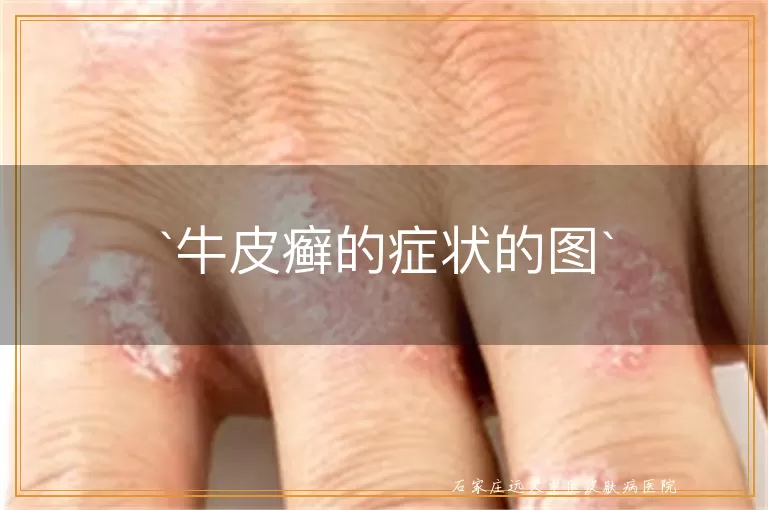 牛皮癣的症状的图