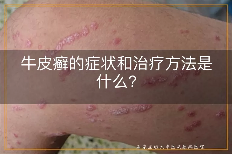 牛皮癣的症状和治疗方法是什么?