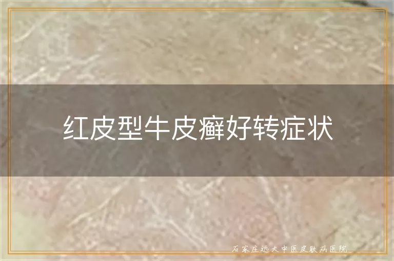 红皮型牛皮癣好转症状
