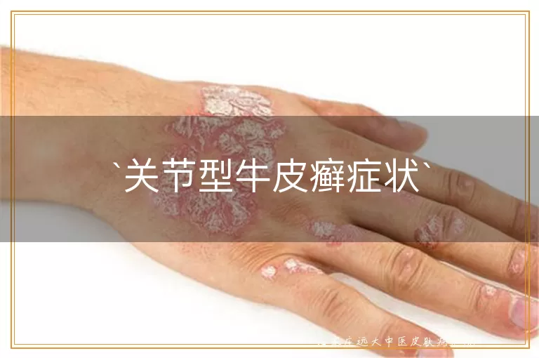 关节型牛皮癣症状
