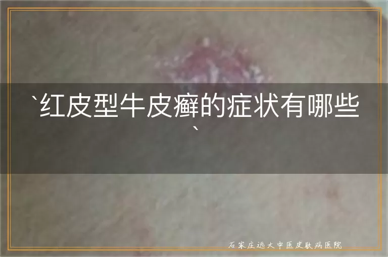 红皮型牛皮癣的症状有哪些