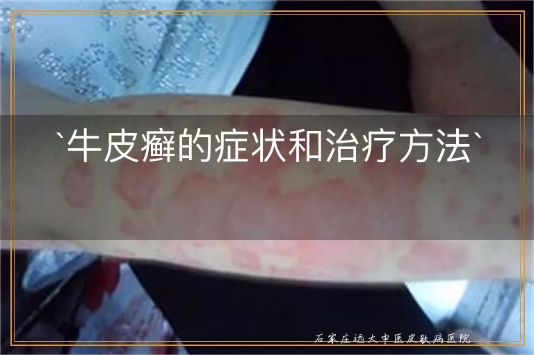 牛皮癣的症状和治疗方法