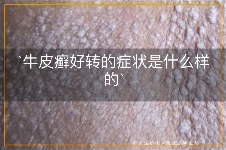 牛皮癣好转的症状是什么样的