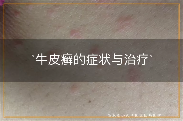 牛皮癣的症状与治疗