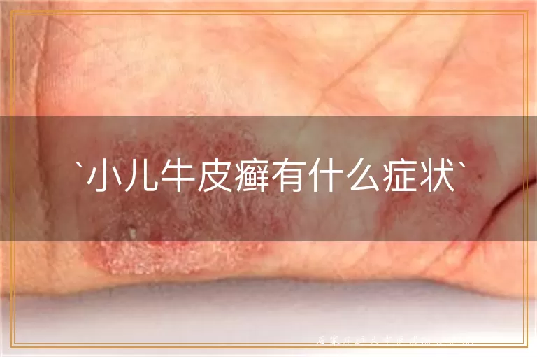 小儿牛皮癣有什么症状